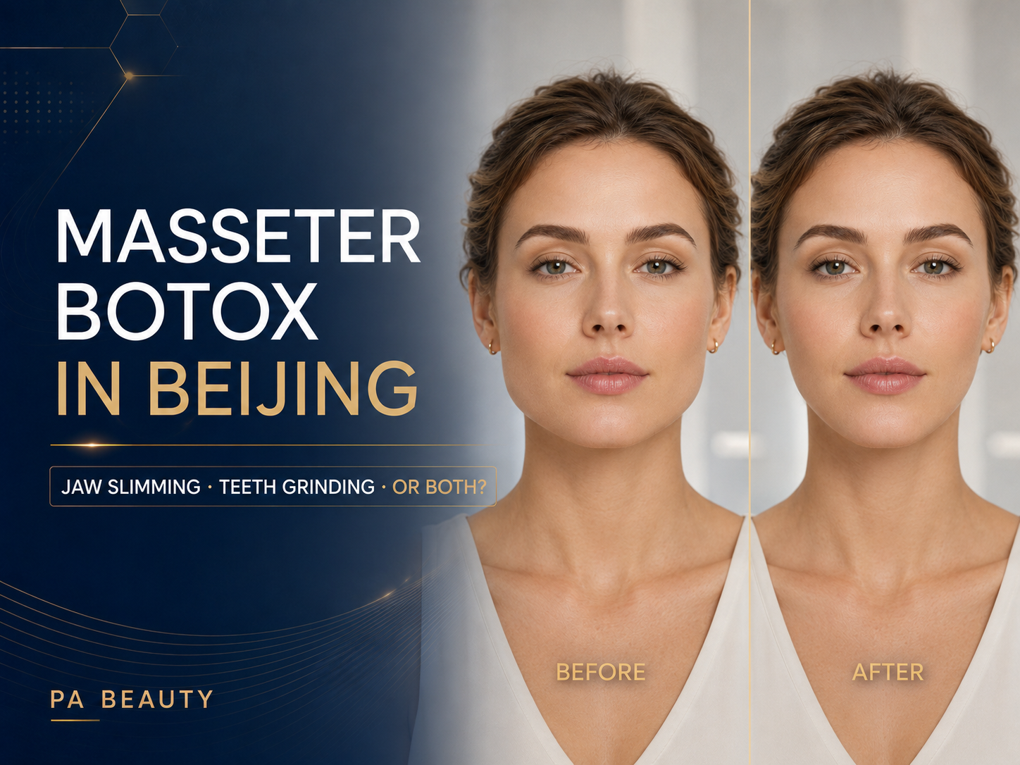 Masseter Botox in Beijing: Jaw Slimming, Teeth Grinding or Both?