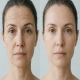 The Fastest Botox for Busy Professionals: Look Refreshed During Your Lunch Break at PA BEAUTY