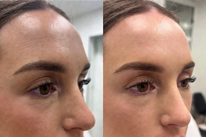 Botox in Beijing (For Expats) | Natural Results, No Frozen Look