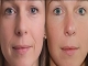 WHY ARE MY SMILE LINES GETTING DEEPER AND WHAT CAN I DO ABOUT IT?
