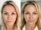 How to improve dark circle around eyes?