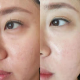 1Elevate Your Beauty with Lumenis TriLift: The Ultimate Facelift_复制