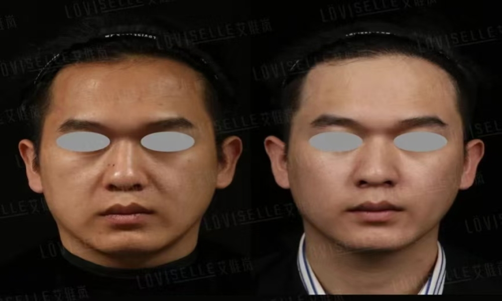 ​Sculptra®: The Ultimate Collagen Stimulator for Natural, Long-Lasting Rejuvenation