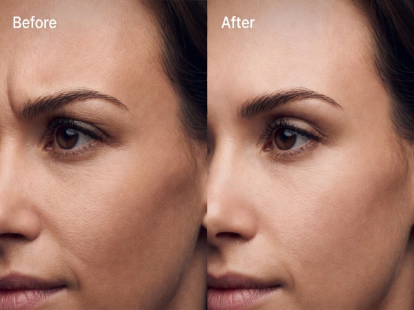 Hyaluronic Acid for Glabellar Frown Lines