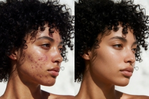 Acne: Why it Happens & Why it Stays