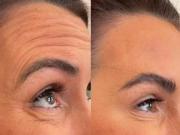 Botox wrinkle removal